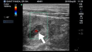 Two Fetal Heartbeats Seen On Er Shun's Recent Ultrasounds